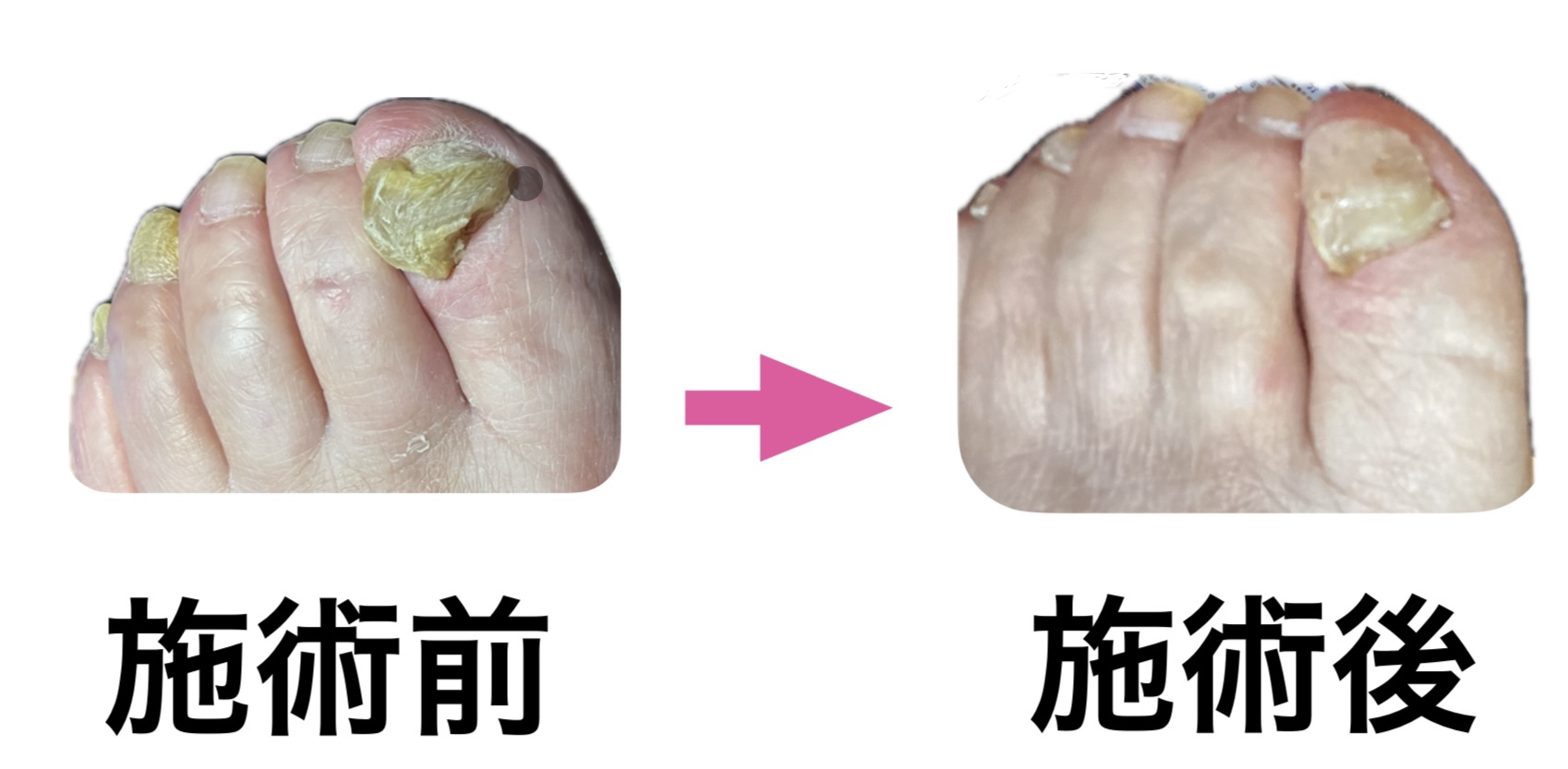 フットケア症例